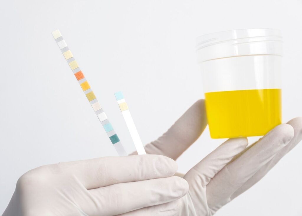 Urine Color Kidney Health, Expert Tips by Dr. Sandeep Morkhandikar